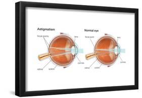 Scleral Buckle. Eye, Ophthalmology, Health and Disease-Encyclopaedia Britannica-Framed Poster