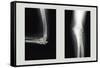 Shattered Elbow Repair-null-Framed Stretched Canvas