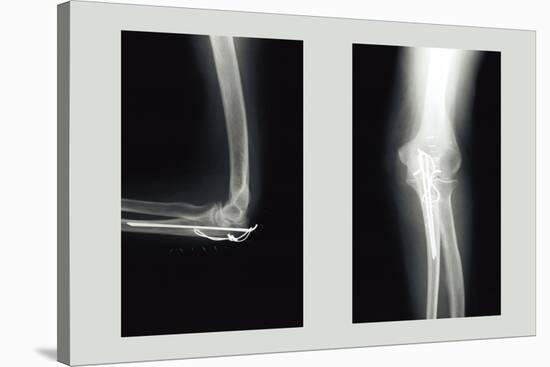 Shattered Elbow Repair-null-Stretched Canvas