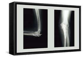 Shattered Elbow Repair-null-Framed Stretched Canvas