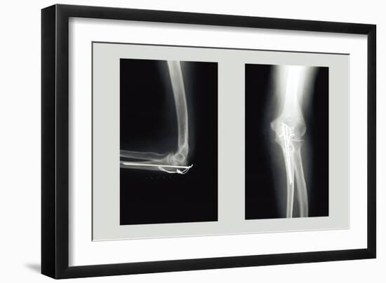 Shattered Elbow Repair-null-Framed Art Print