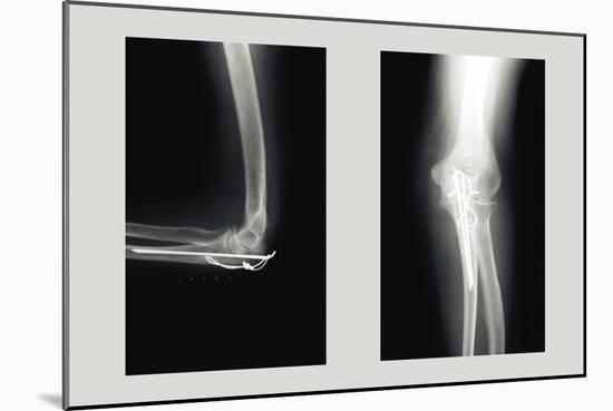 Shattered Elbow Repair-null-Mounted Art Print