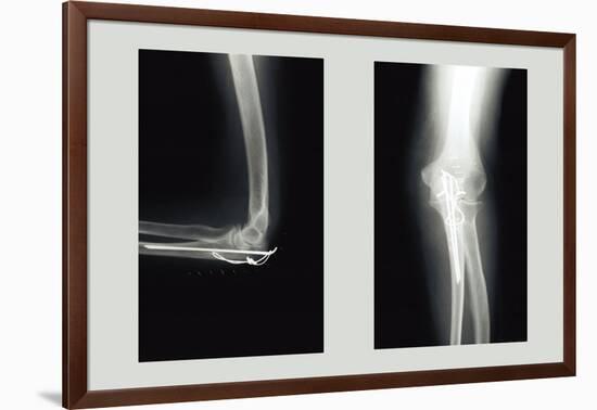 Shattered Elbow Repair-null-Framed Art Print