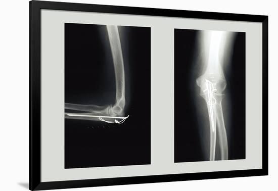 Shattered Elbow Repair-null-Framed Art Print