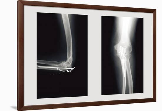 Shattered Elbow Repair-null-Framed Art Print