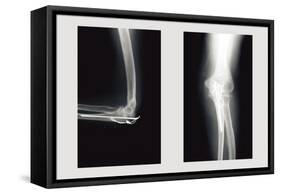 Shattered Elbow Repair-null-Framed Stretched Canvas