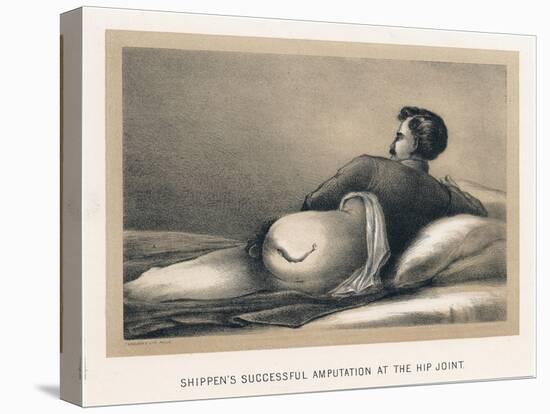 Shippen's Successful Amputation at the Hip Joint, American Civil War, 1865-null-Stretched Canvas