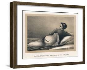 Shippen's Successful Amputation at the Hip Joint, American Civil War, 1865-null-Framed Giclee Print