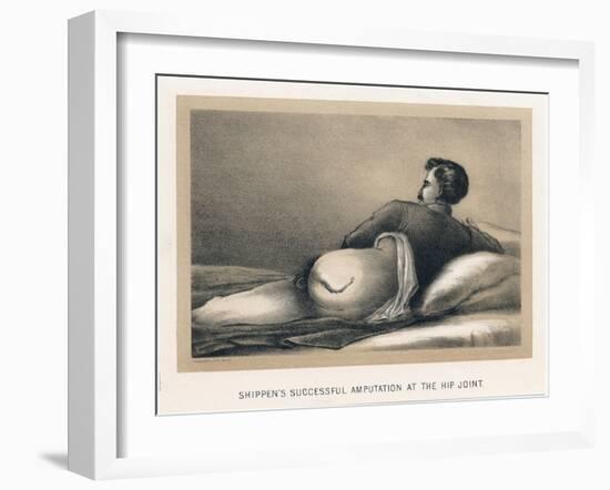 Shippen's Successful Amputation at the Hip Joint, American Civil War, 1865-null-Framed Giclee Print