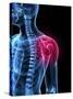 Shoulder Pain, Conceptual Artwork-SCIEPRO-Stretched Canvas