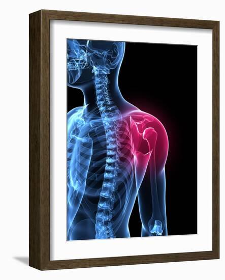 Shoulder Pain, Conceptual Artwork-SCIEPRO-Framed Photographic Print