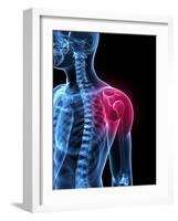 Shoulder Pain, Conceptual Artwork-SCIEPRO-Framed Photographic Print