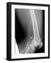 Shrapnel Injury, X-ray-Du Cane Medical-Framed Photographic Print