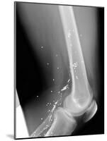 Shrapnel Injury, X-ray-Du Cane Medical-Mounted Photographic Print