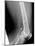 Shrapnel Injury, X-ray-Du Cane Medical-Mounted Photographic Print
