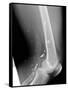 Shrapnel Injury, X-ray-Du Cane Medical-Framed Stretched Canvas