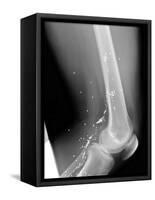 Shrapnel Injury, X-ray-Du Cane Medical-Framed Stretched Canvas