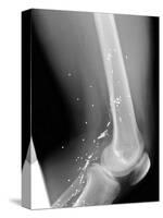 Shrapnel Injury, X-ray-Du Cane Medical-Stretched Canvas