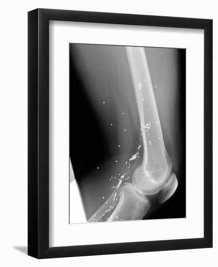 Shrapnel Injury, X-ray-Du Cane Medical-Framed Photographic Print