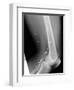 Shrapnel Injury, X-ray-Du Cane Medical-Framed Photographic Print