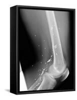 Shrapnel Injury, X-ray-Du Cane Medical-Framed Stretched Canvas