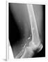 Shrapnel Injury, X-ray-Du Cane Medical-Framed Photographic Print