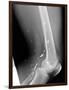 Shrapnel Injury, X-ray-Du Cane Medical-Framed Photographic Print