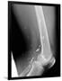 Shrapnel Injury, X-ray-Du Cane Medical-Framed Photographic Print