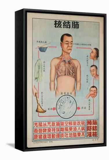 Sick People Can Spread Tb Through Bodily Discharges-null-Framed Stretched Canvas