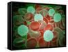 Sickle Cell Anemia with Red Blood Cells and White Bood Cells-null-Framed Stretched Canvas