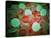 Sickle Cell Anemia with Red Blood Cells and White Bood Cells-null-Stretched Canvas