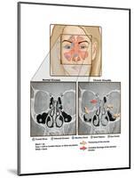 Sinuses and Sinusitis-Science Source-Mounted Art Print