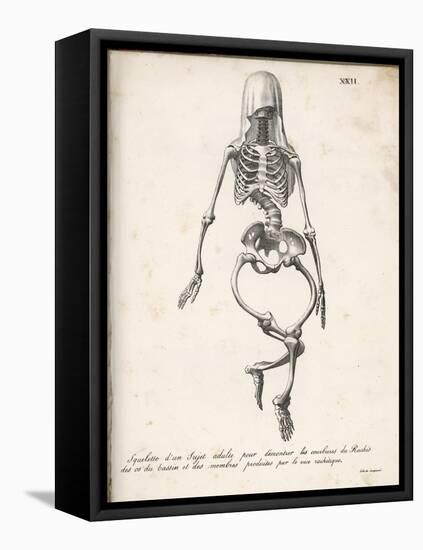 Skeleton of an Adult Patient Afflicted with Rickets-Langlume-Framed Stretched Canvas