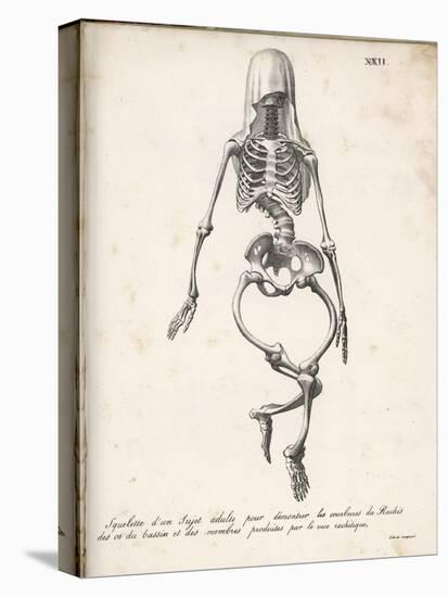 Skeleton of an Adult Patient Afflicted with Rickets-Langlume-Stretched Canvas