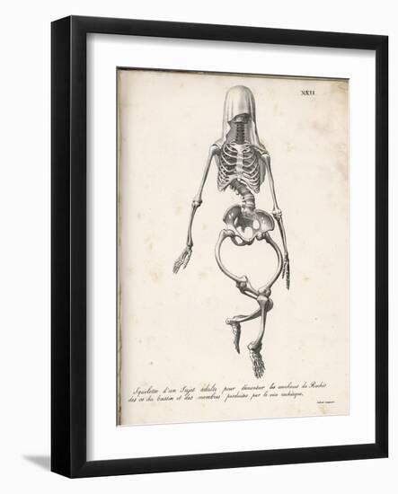 Skeleton of an Adult Patient Afflicted with Rickets-Langlume-Framed Art Print