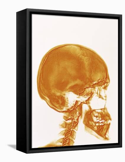 Skull X-ray-PASIEKA-Framed Stretched Canvas