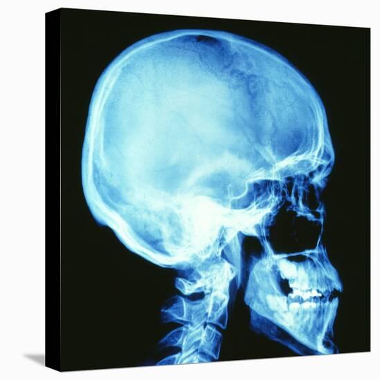 Skull X-ray-PASIEKA-Stretched Canvas