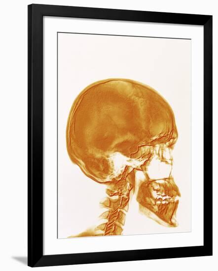 Skull X-ray-PASIEKA-Framed Photographic Print