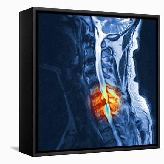 Slipped Disc, MRI Scan-PASIEKA-Framed Stretched Canvas