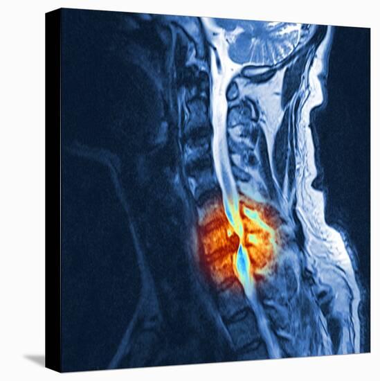 Slipped Disc, MRI Scan-PASIEKA-Stretched Canvas