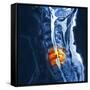 Slipped Disc, MRI Scan-PASIEKA-Framed Stretched Canvas