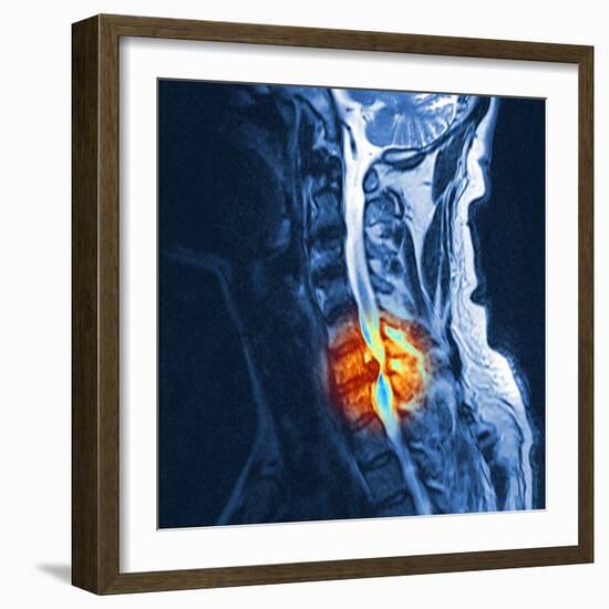 Slipped Disc, MRI Scan-PASIEKA-Framed Premium Photographic Print