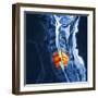 Slipped Disc, MRI Scan-PASIEKA-Framed Premium Photographic Print