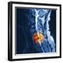 Slipped Disc, MRI Scan-PASIEKA-Framed Premium Photographic Print