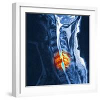 Slipped Disc, MRI Scan-PASIEKA-Framed Premium Photographic Print