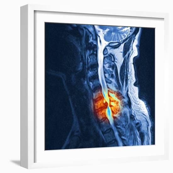 Slipped Disc, MRI Scan-PASIEKA-Framed Premium Photographic Print