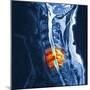 Slipped Disc, MRI Scan-PASIEKA-Mounted Premium Photographic Print