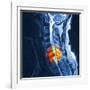 Slipped Disc, MRI Scan-PASIEKA-Framed Photographic Print