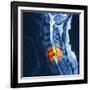 Slipped Disc, MRI Scan-PASIEKA-Framed Photographic Print