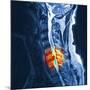 Slipped Disc, MRI Scan-PASIEKA-Mounted Photographic Print